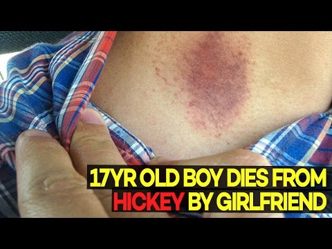 A 17-Year-Old Boy DIED After Getting a Hickey from Girlfriend