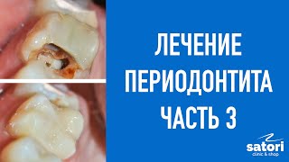 Treatment of periodontitis part 3. Restoration of a tooth on a pin.