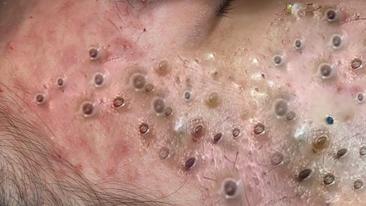 𝑪𝒚𝒔𝒕𝒊𝒄 𝑨𝒄𝒏𝒆 𝑹𝒆𝒎𝒐𝒗𝒂𝒍 & 𝑰𝒏𝒇𝒍𝒂𝒎𝒎𝒂𝒕𝒐𝒓𝒚 𝑨𝒄𝒏𝒆 #𝟖𝟔𝟖𝟔𝟕𝟔