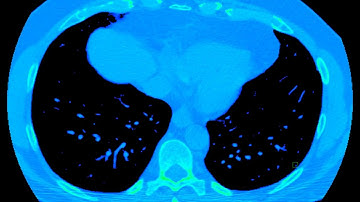 Lung cancer detection with CT scans using AI