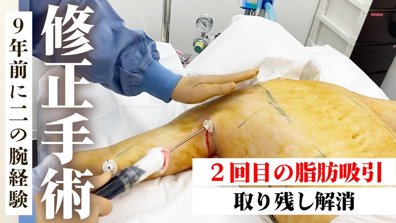 If you feel that your liposuction has failed, consult Dr