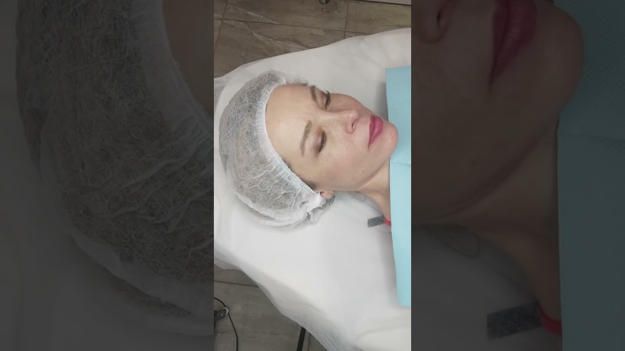 Прев'ю відео: Процес біоревіталізації