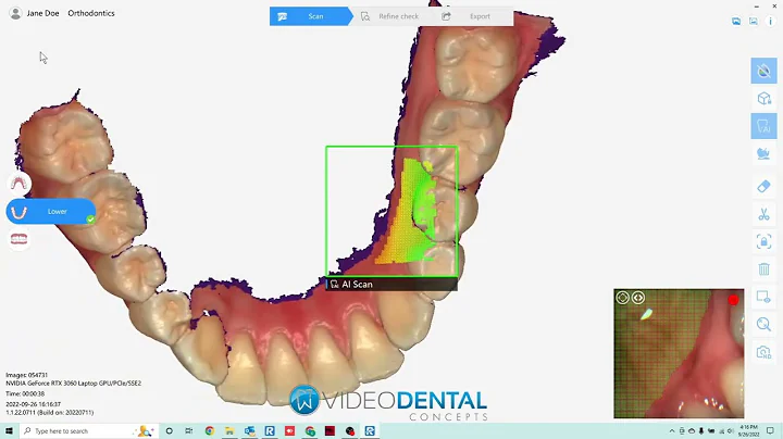 QuickScan IOS by Runyes in Action! New 3D Intraoral Scanner to Meet Your Digital Dentistry Needs.