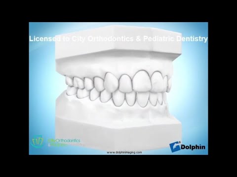 How Molds of Teeth Are Taken | City Orthodontics & Pediatric Dentistry Edmonton