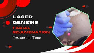 Laser Genesis | Facial Rejuvenation | Texture and Tone | West Hollywood, CA | Dr. Jason Emer