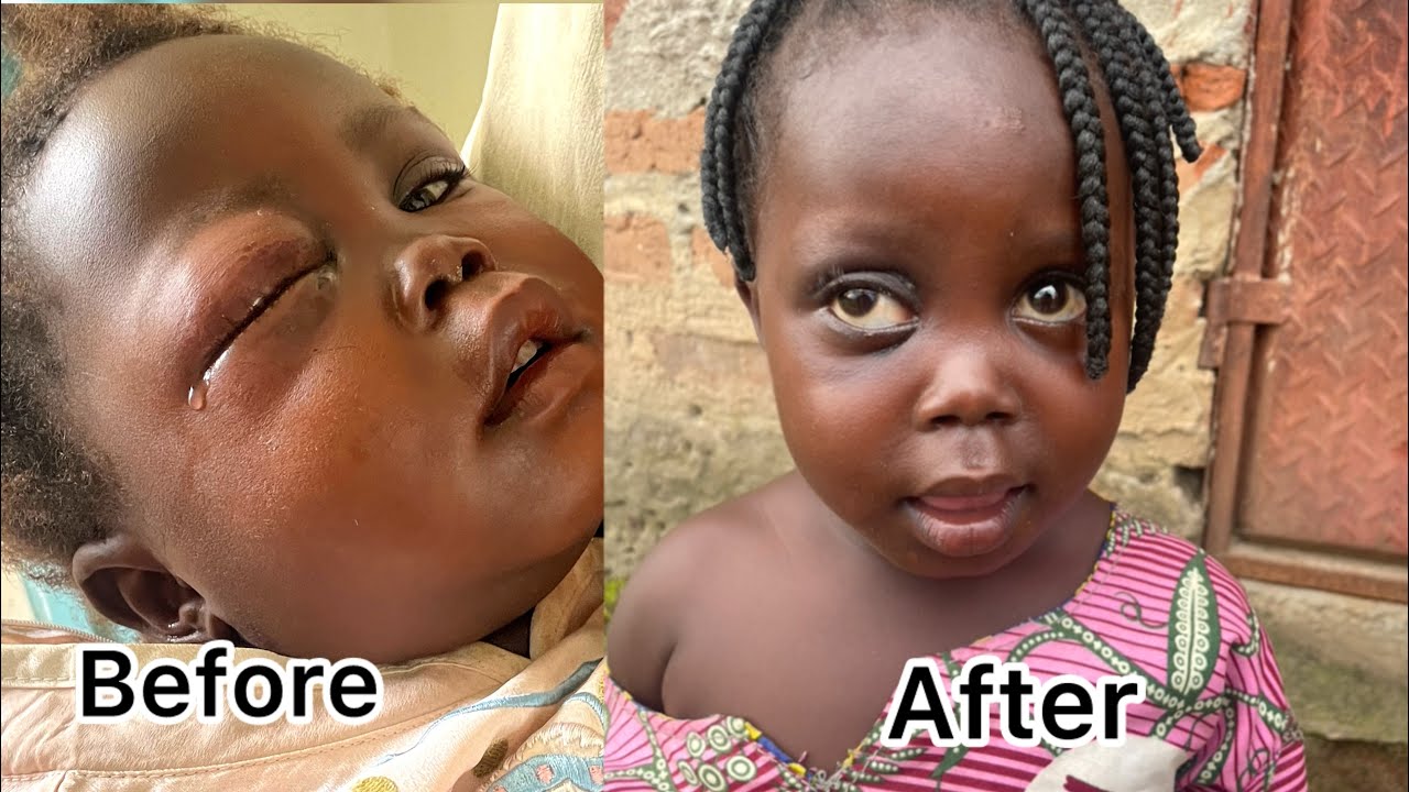 Baby Mercy&rsquo;s eye saved out of becoming blind