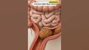 Colon Obstruction Explained in 3D  Probiotic Pixels  #digestivehealth #3danimation