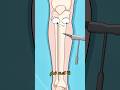 كسر العظام لزيادة الطول حقيقة خطيرة 2danimation Webtoon Funny Didyouknow Shorts