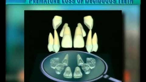 Clip 14: Changes of Maxillary Permanent Incisors after Extraction of Deciduous Canines in Crowding