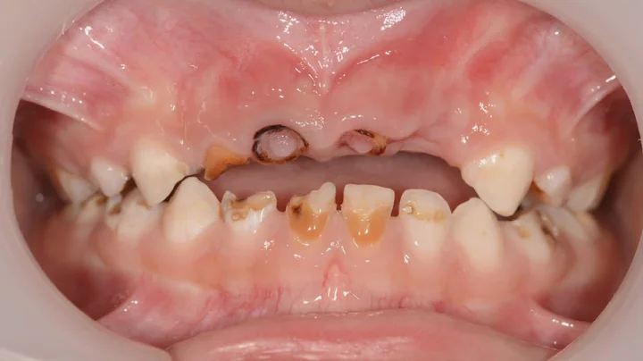 Children's rotting teeth costs NHS £35m a year - DayDayNews