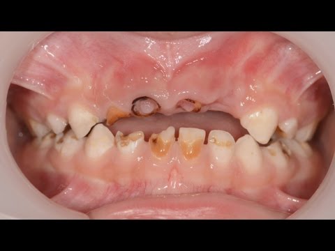 Video: Hvorfor Forværres Et Lille Barns Tænder?