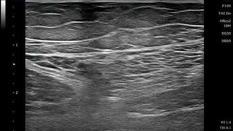 Saphenous nerve, infrapatellar branch