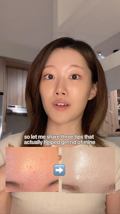 3 skincare tips to remove closed comedones