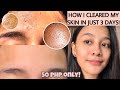 HOW TO GET RID OF TINY BUMPS ON FOREHEAD/FACE FAST | FUNGAL ACNE (how i cleared my skin) [ENG SUB]