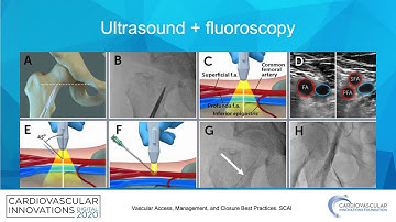 Large Bore Access_Gutierrez_Peripheral on Demand