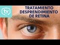 El tratamiento del desprendimiento de retina