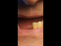 Full Arch Dental Implants Explained Why One Tooth at a Time Is Not Enough #shorts