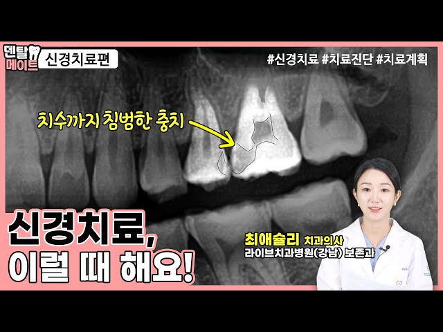 신경치료 이럴 때 해요!  [신경 치료, 신경손상 자가확인법, 신경 치료 과정]｜덴탈메이트