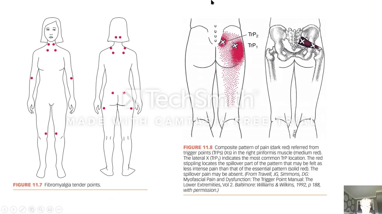 Fibromyalgia Myofascial Pain Syndrome Sensory Pathways Pain [FF NPTE 2 ...