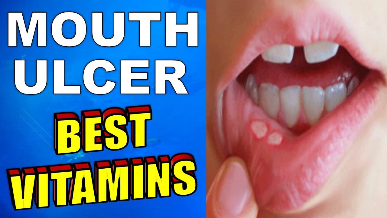 What is the BEST VITAMIN for MOUTH ULCERS - YouTube