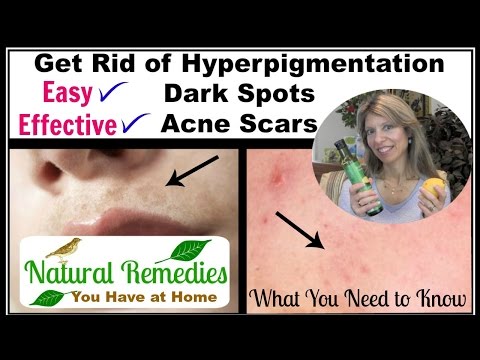 Get Rid of Hyperpigmentation, Dark Spots, Dark Upper Lip, Acne Scars | Natural Remedies for Skin