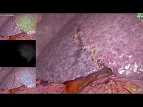 LAPAROSCOPIC RIGHT HEPATIC VENOUS DRAINAGE AREA RESECTION BY INDOCYANINE GREEN ICG FLUORESCENT NEGAT