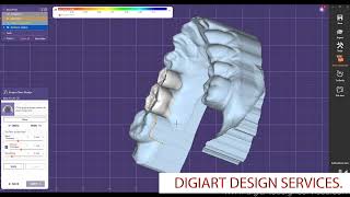 Exocad : Design perfect RPD in 5 minutes