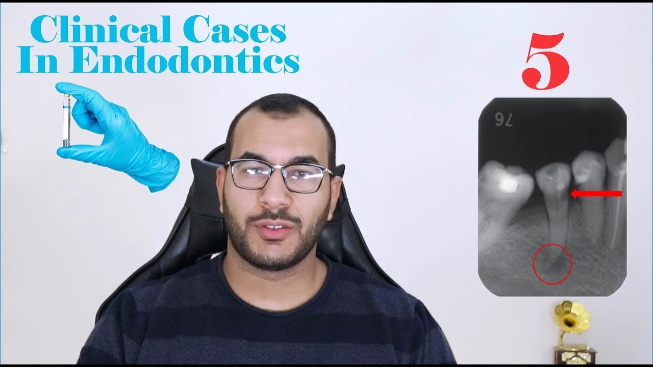 Clinical Cases in Endodontics part 5 YouTube
