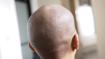 How to Create 3D Scalp Micropigmentation Hair Tattoo?