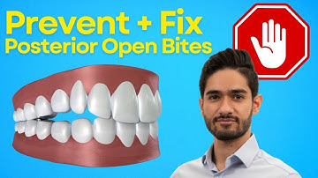 How to Fix & Prevent Posterior Open Bites with Invisalign Clear Aligners