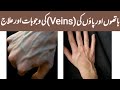 How To get ride of Hands and Body Veins Naturally || Hands Veins Treatment || Beauty Tips 123