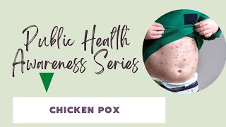 Chicken Pox | Laakra Kaakra | Varicella | Public Health Awareness Series | Lecture 29