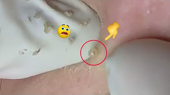 Acne Popping 2019 - YouTube