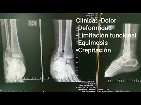 Reducción de LuxoFractura de Tobillo