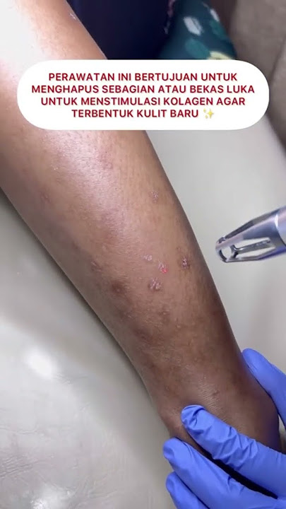 ATASI BEKAS LUKA DENGAN LASER YELLO BY PESONA AYU #klinikkecantikan #pesonaayu #treatment #bekasluka