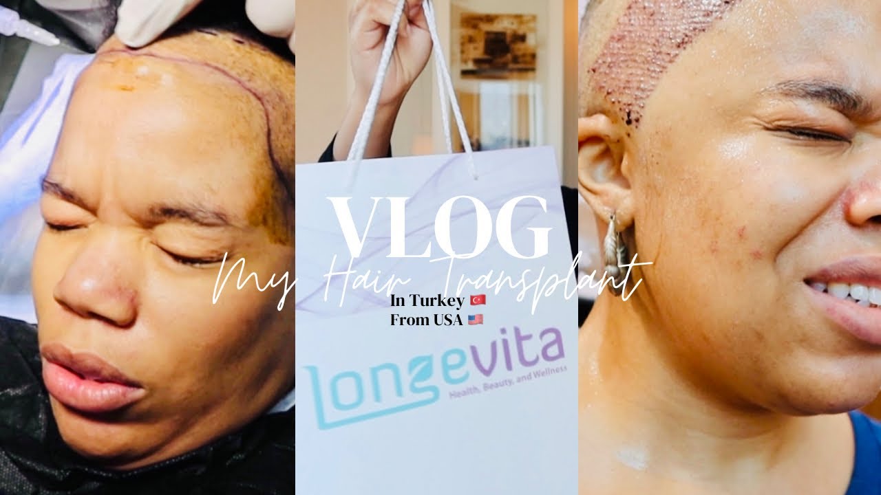 My Full Experience getting a FUE Hair Transplant Vlog in Istanbul Turkey (Very Detailed) Longevita
