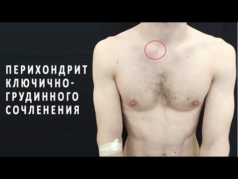 Симптомы и лечение перихондрита ключично-грудинного сочленения