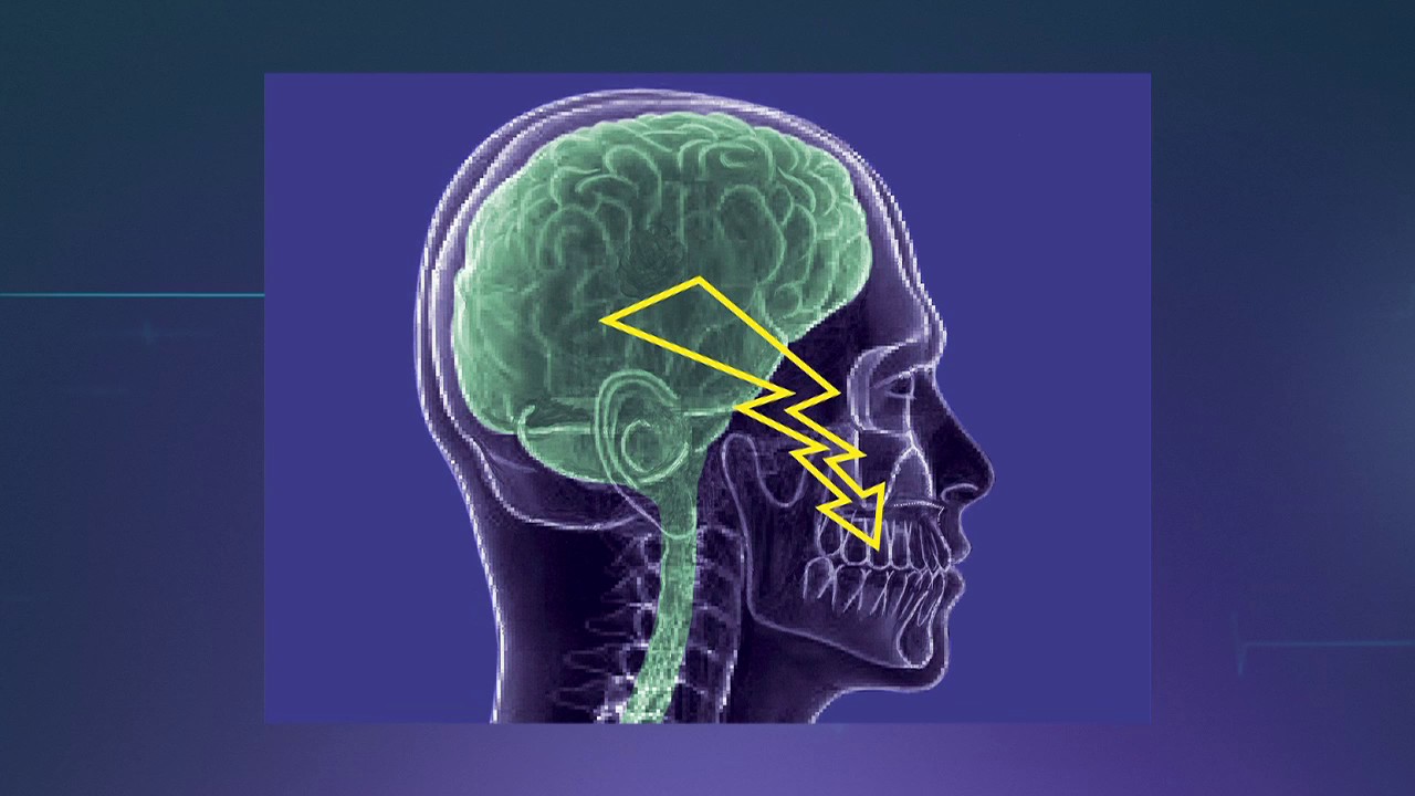  Trigeminusneuralgie Hirslanden TeleZ ri Gesundheitssendung 