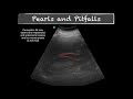 Pocus   e fast  pitfalls