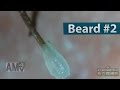 #02 Pull Out Beard, Blackhead and Hair Root(Root Sheath) Close up