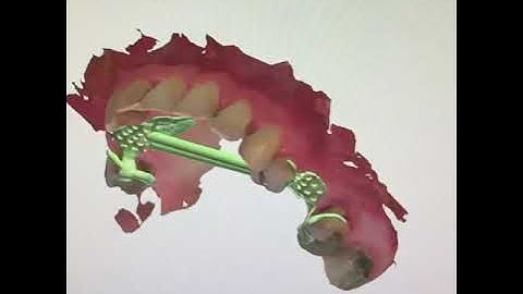 Digital Removable Partial Denture