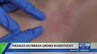 Full Kentucky measles outbreak grows to 24 cases across 7 counties Guide