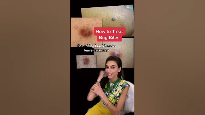 How to Treat Bug Bites #shorts | SkinByDrAzi
