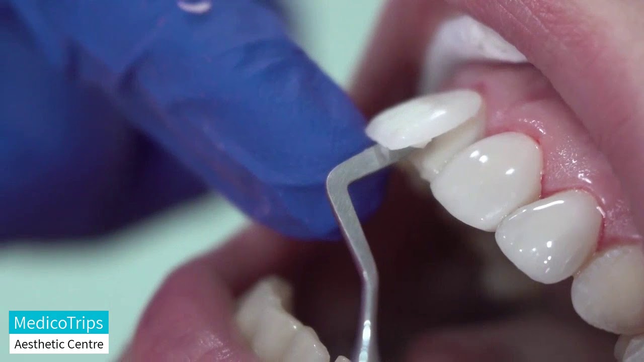 DENTAL VENEERS YouTube