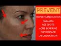 How to PREVENT HYPERPIGMENTATION &amp; How to Cover it up w/ makeup -  SPF - IT Cosmetics CC Cream