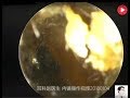 Earwax Removal Extraction,oil ears, small lumps, dry pick, 12 minutes