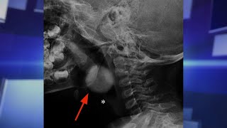 Must-Know Child Choking Hazards Net Worth