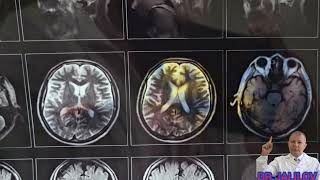 Maniakal-Depressiv Psixoz - Kasallik Belgilari, Diagnostika Va Davolash