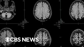 How CTE factors into the NYC mass shooting near the NFL headquarters