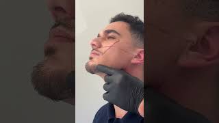 Jawline &amp; Cheek Filler⁠